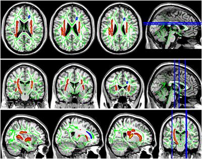 Research on the Mechanism of Cognitive Decline in Patients With Acoustic Neuroma